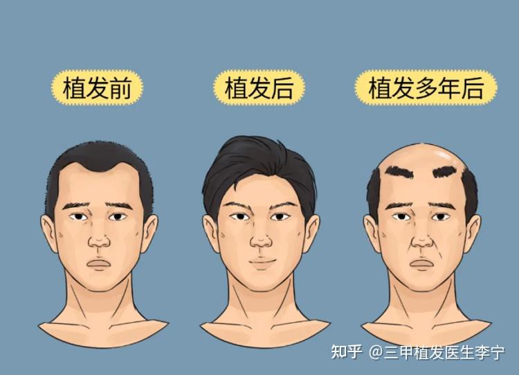 植发技术有多少年了植发的老了之后会变成小龙人两个角的样子吗