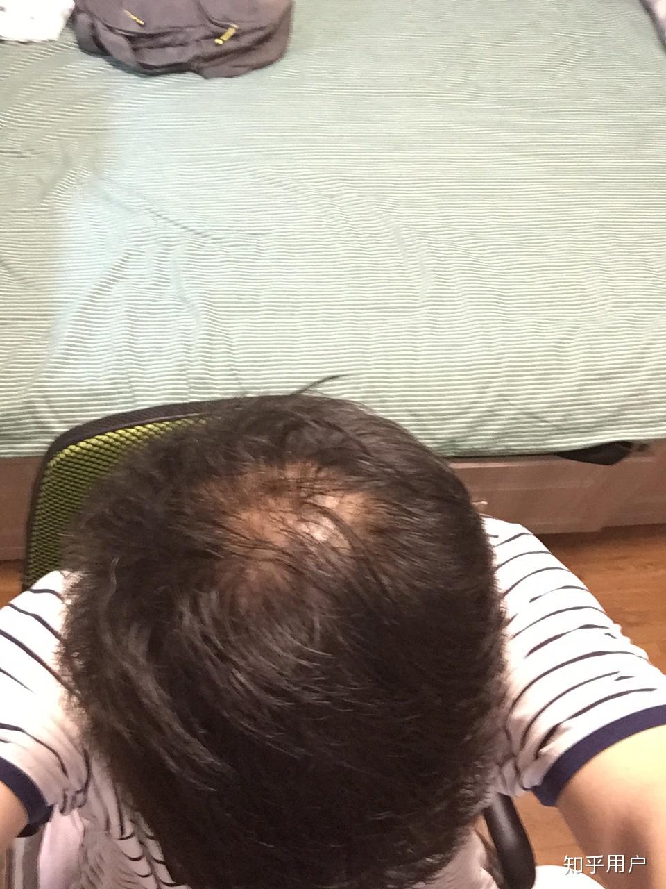 15岁头发光成这样是秃头了吗