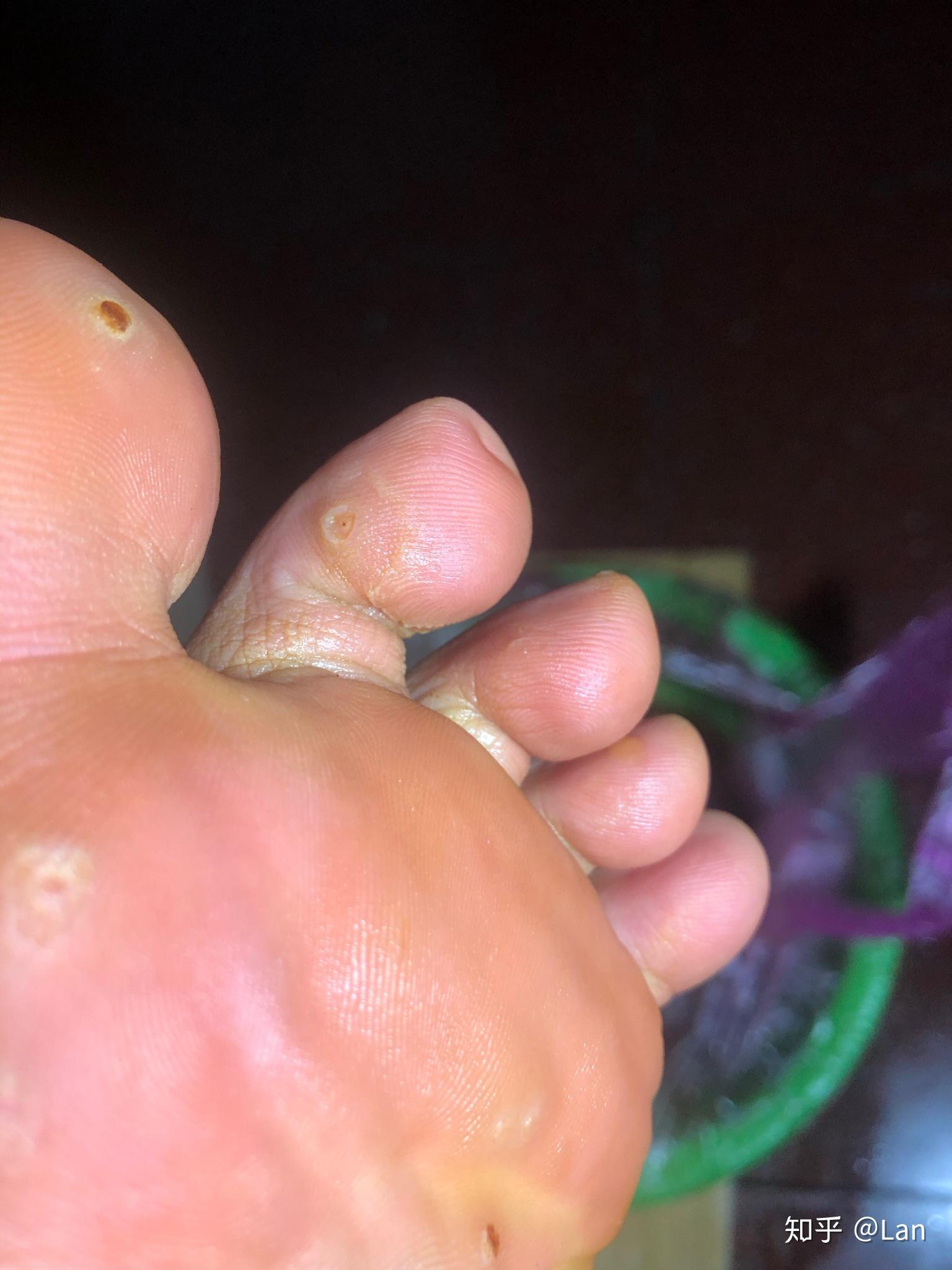 火针治疗跖疣一点感受