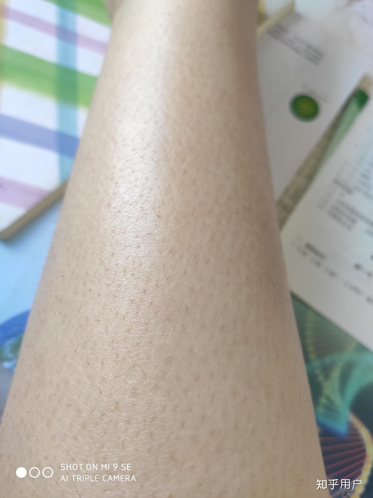 胳膊上的鸡皮肤好养(怎么改善胳膊上的鸡皮肤)
