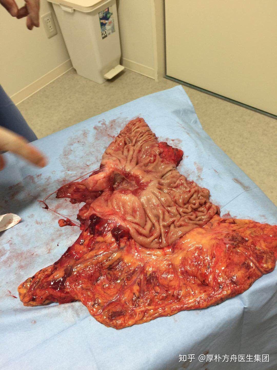 通过手术取下的癌组织是什么样子的