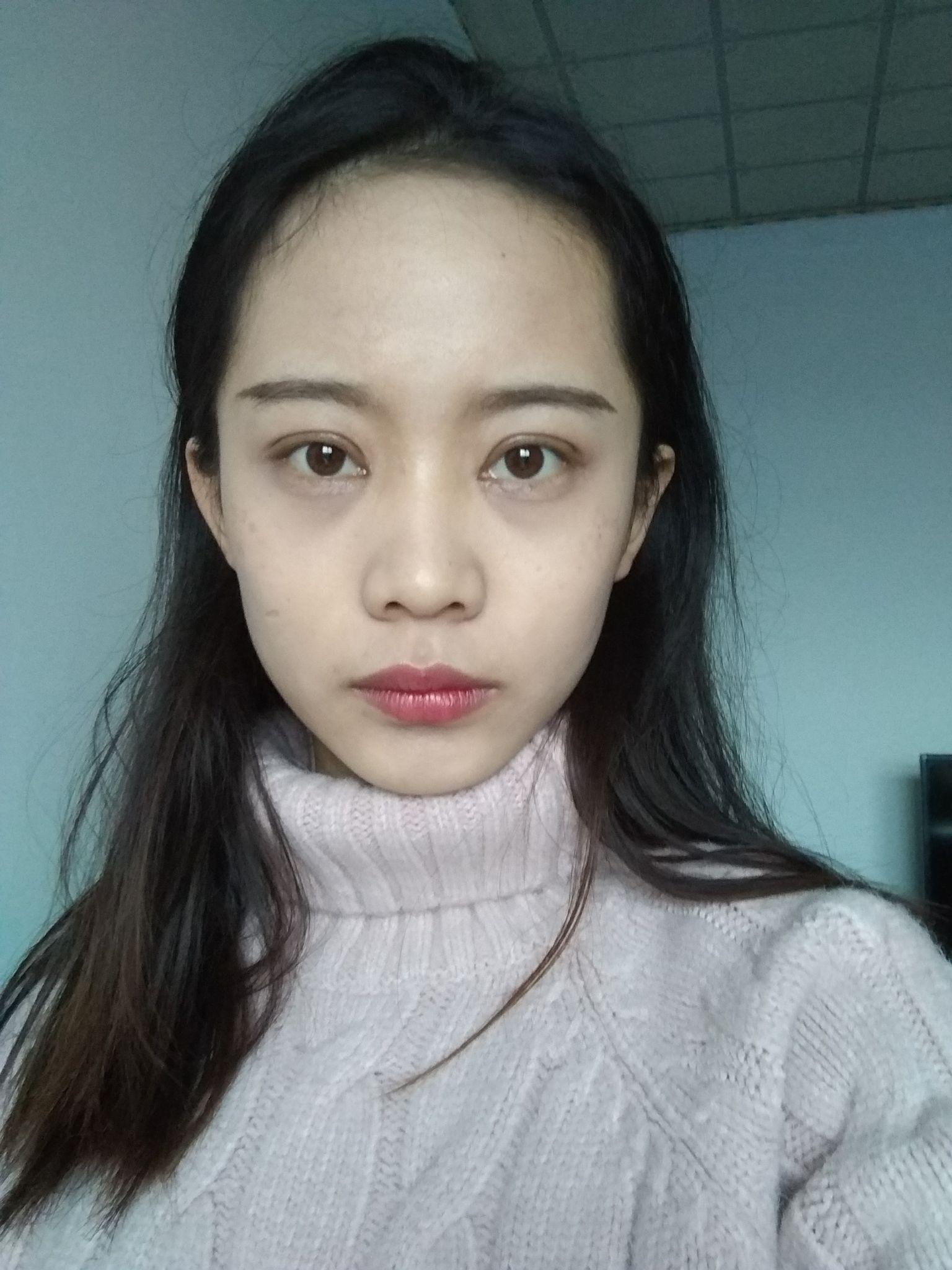 双眼皮 全切6mm&开眼角 - 知乎