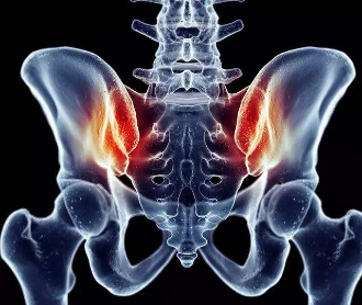 有一种腰痛叫骶髂关节紊乱