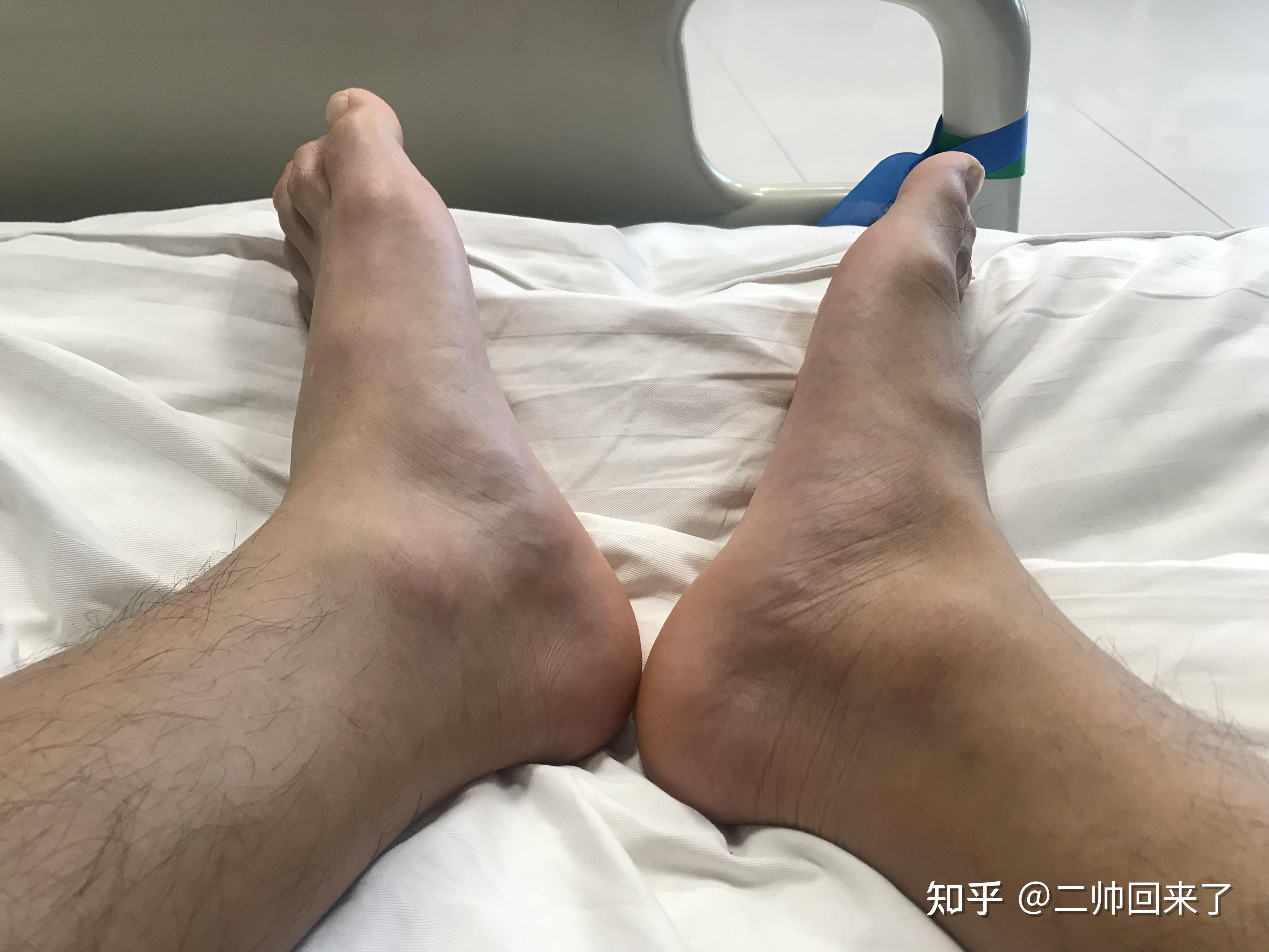 医生给做的标记,说是此处跟腱断裂,有明显肿胀,跟腱的轮廓已经看不