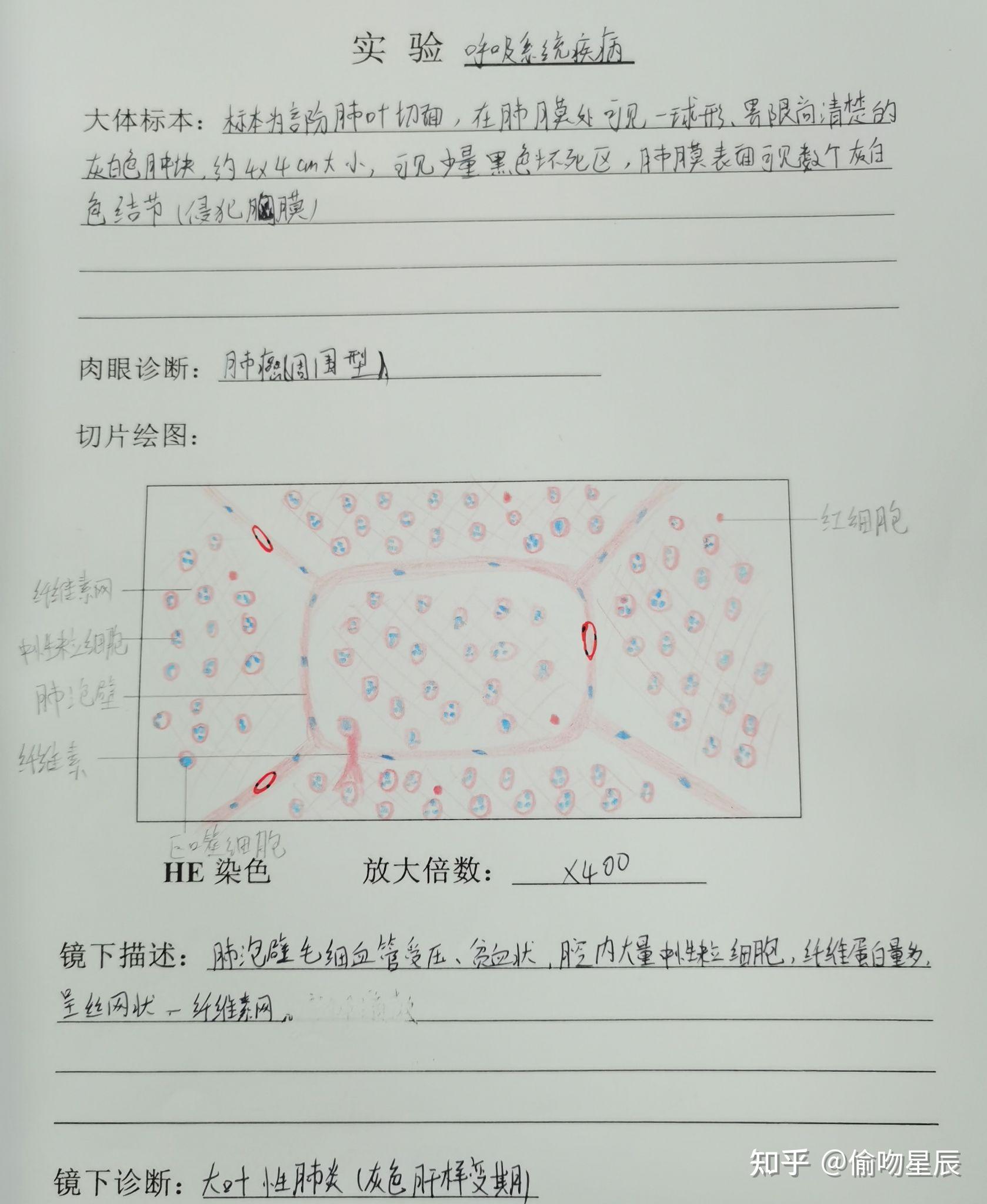有没有人有病理的结肠腺癌红蓝铅笔手绘图啊? - 知乎