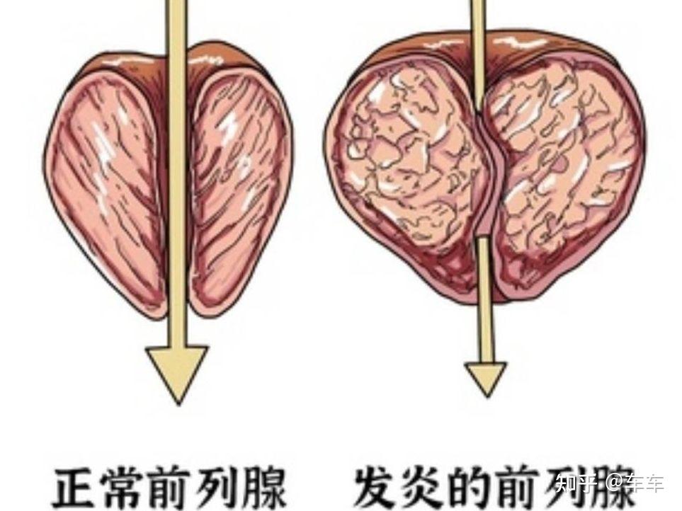 尿道口有粘液,粘絲或膿性分沁物,尿混濁或大便後尿道口有白色液體流出