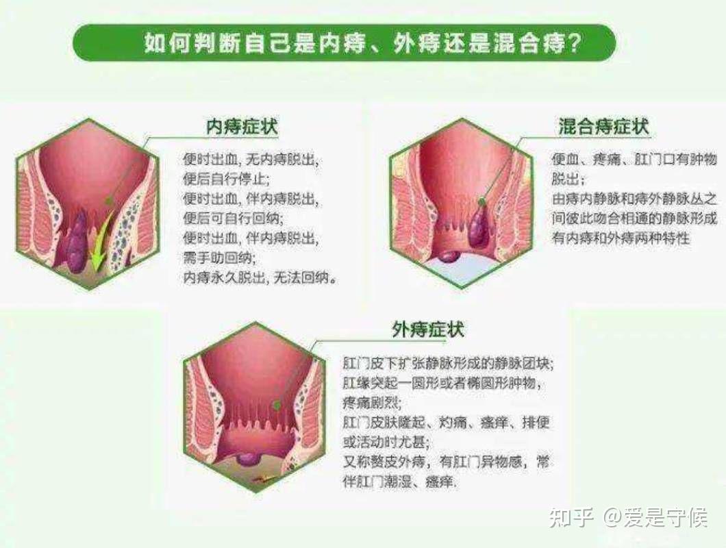 长痔疮怎么办有肉球图片