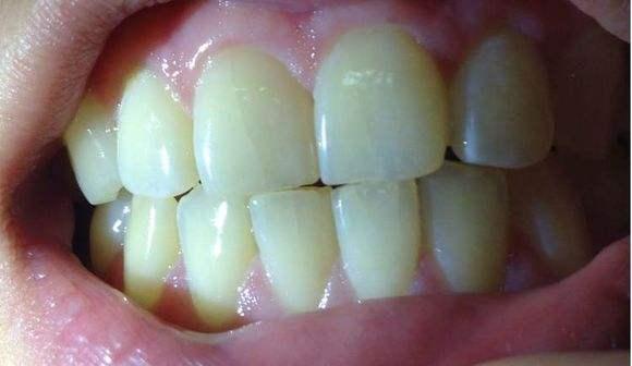 嗑瓜子的时候把牙齿皮裂了牙齿有条隐隐的裂缝怎么办