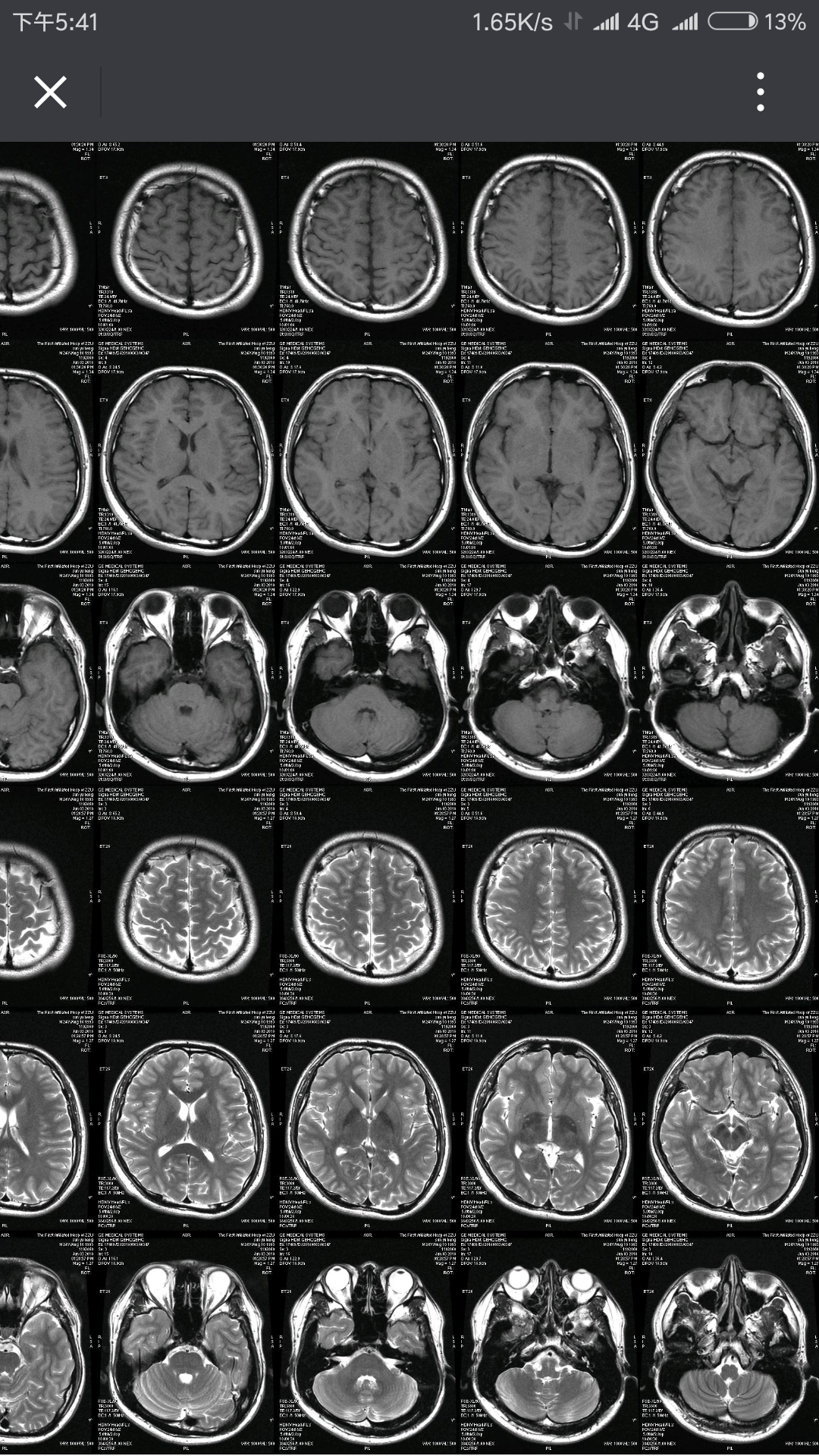 颅脑的正常MRI图片图片
