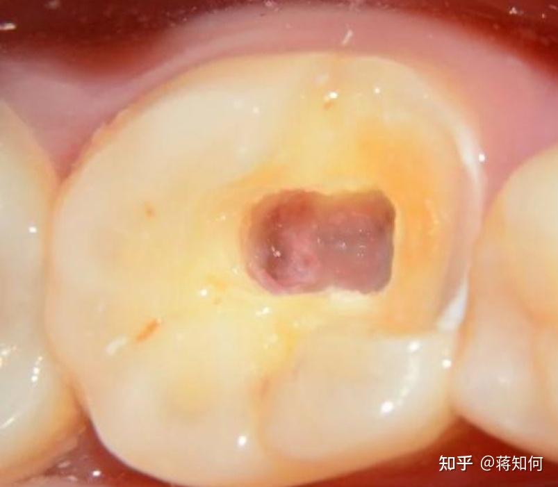 牙神经怎么杀死,杀死之后做根管还疼吗? - 知乎