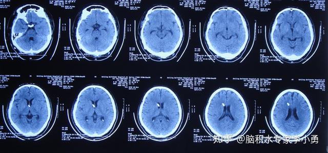 脊柱骨科頸椎病後路減壓術後顱內感染致呼吸困難胸腔積液和肺炎1例經