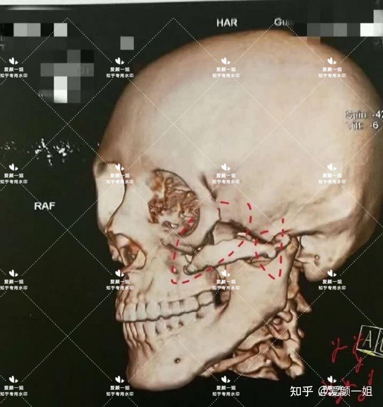 颧骨内推ct图片