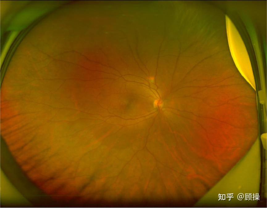 眼底照相对于筛查视网膜裂孔和变性区非常有意义散瞳后三面镜检查对