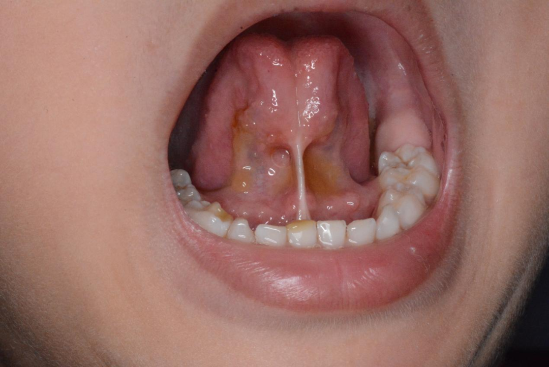 舌系带剪还是不剪?看完让你不纠结 - 知乎