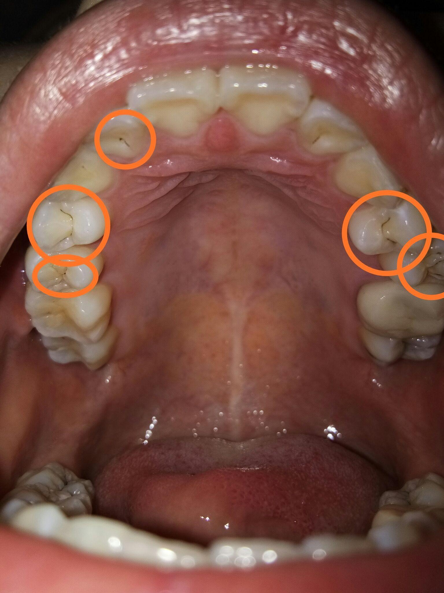 蛀牙,黑线? - 知乎