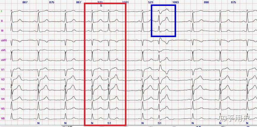 十二导联心电图 标准图片