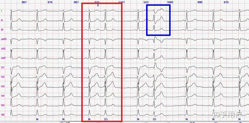 请问怎么看心电图12导联的的那种全图看完了各种讲解还是一脸懵逼感觉