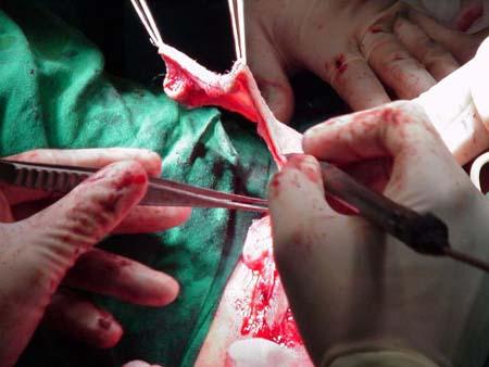 变性(易性癖患者)手术后,尽量不要吃这几样