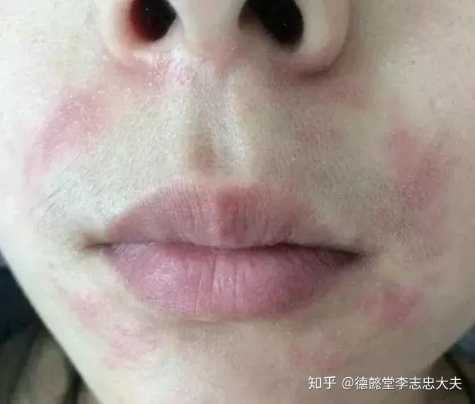 嘴巴一圈发红长疙瘩、脓疱?小心口周皮炎来袭! - 知乎
