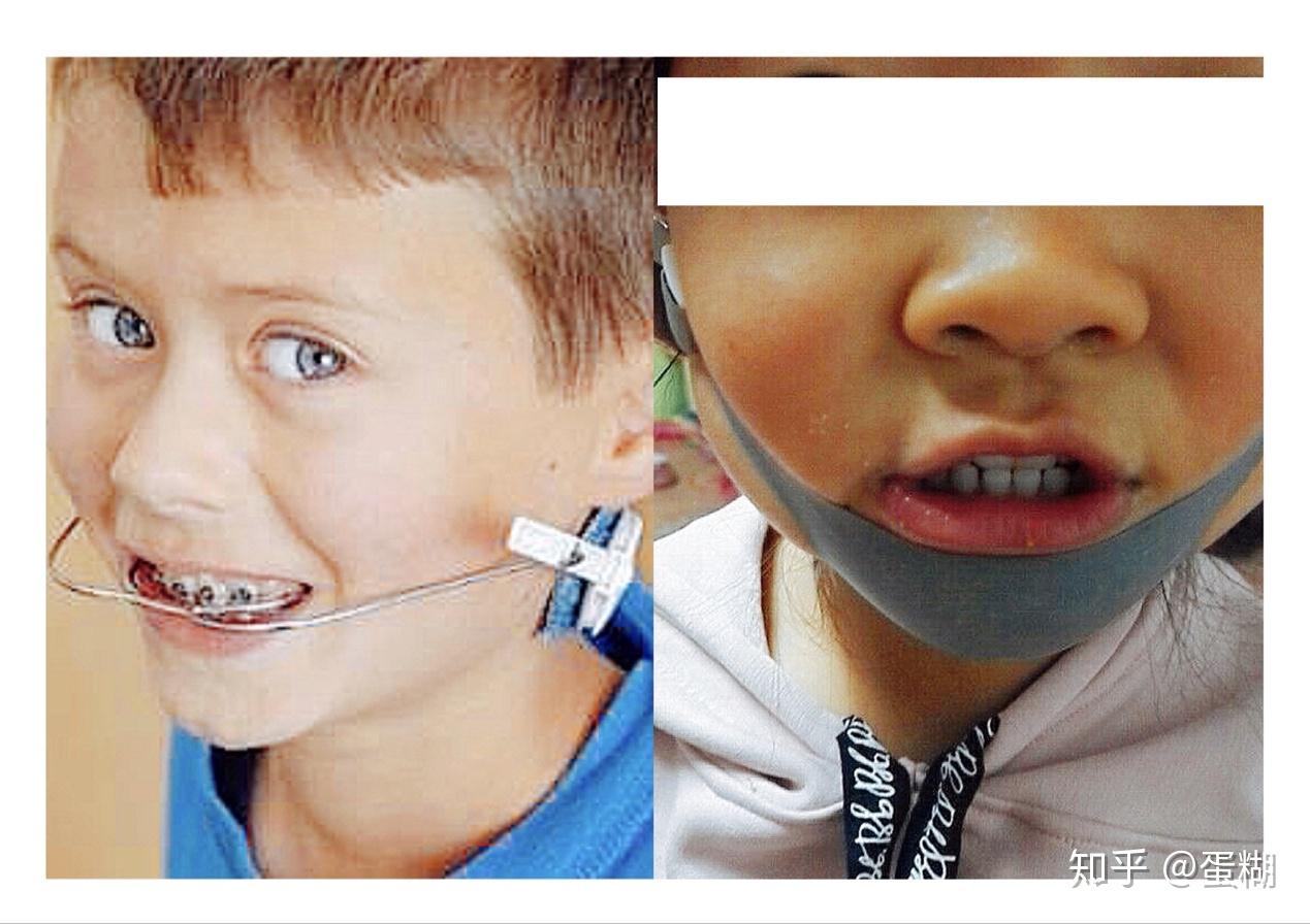 小孩牙齿地包天怎么矫正？
