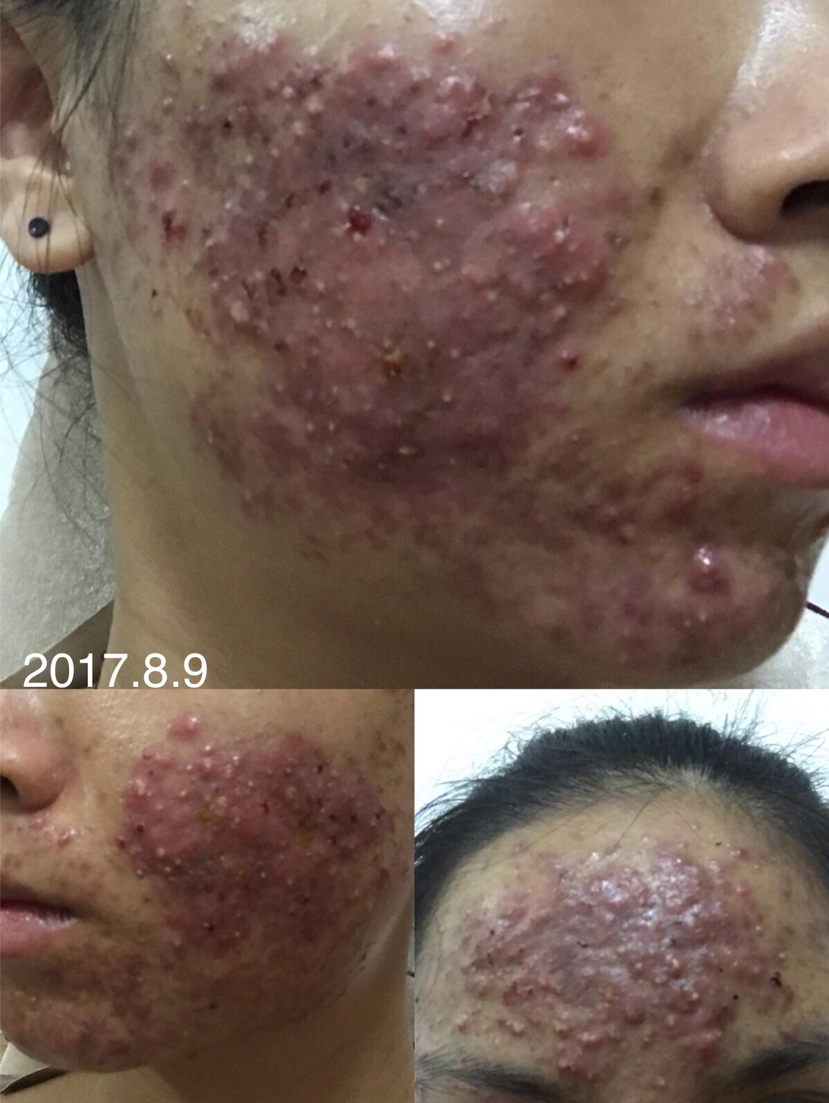 201911更新来了超级严重痤疮和痘坑痘印疤痕的治疗过程记录多图异常