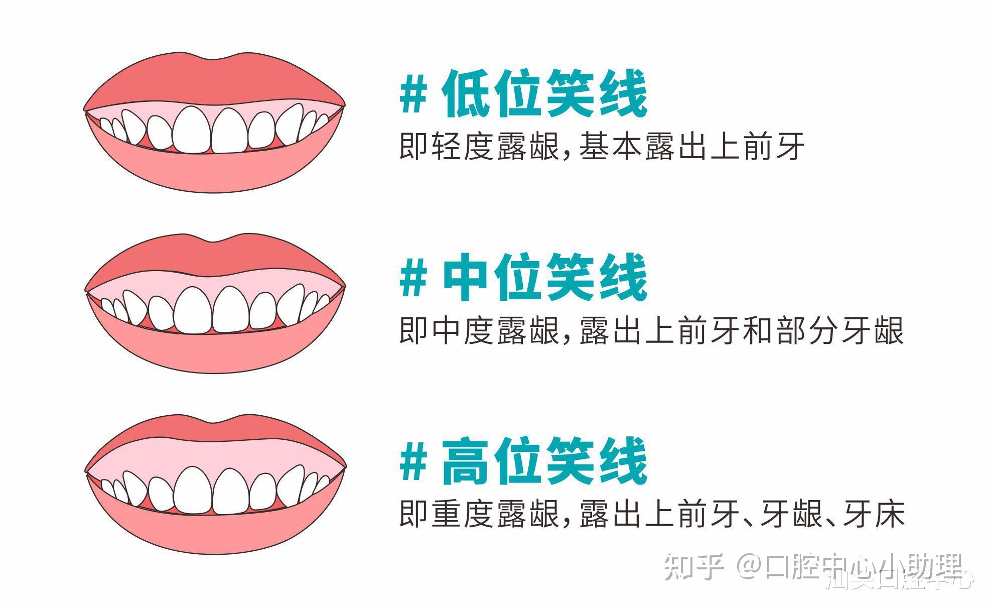 正畸中的颊廊与笑线分别指什么？ - 知乎