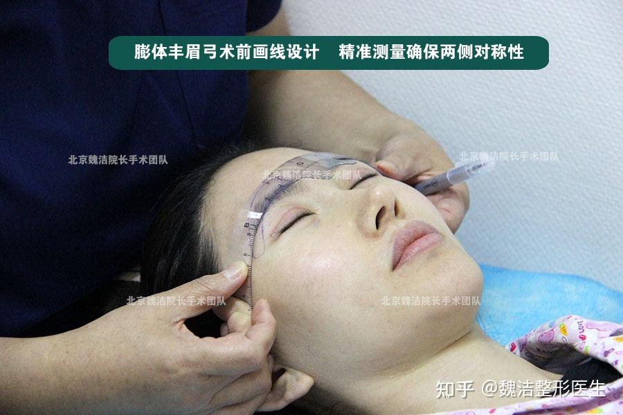 膨体眉弓假体雕刻的核心需尊重眉骨生理结构、契合美学规律 呈现弧度弯曲顺延眶骨缘 北京魏洁 - 知乎