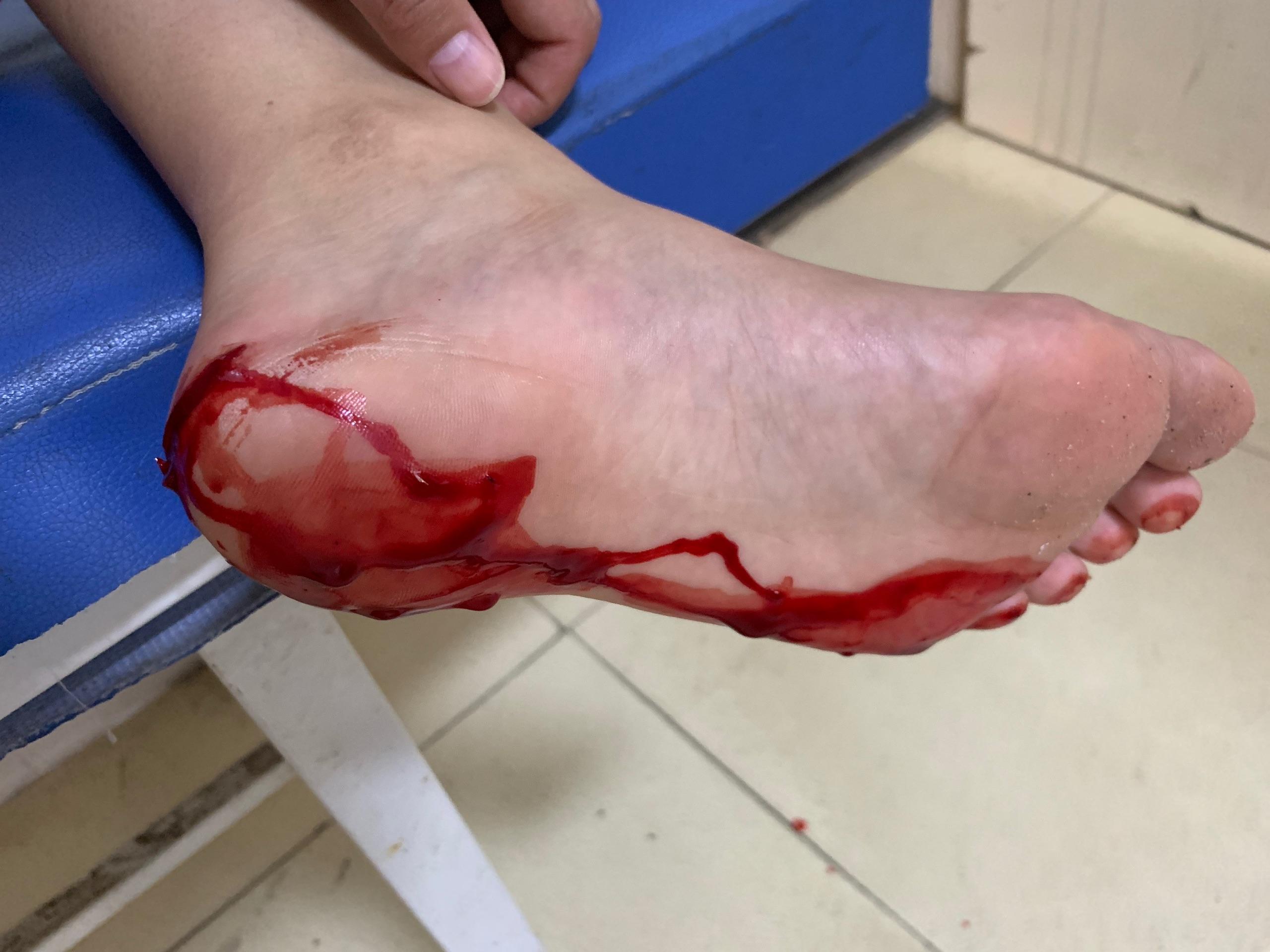缝针痛还是拆线痛