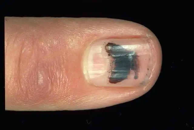 黑素瘤指甲图片