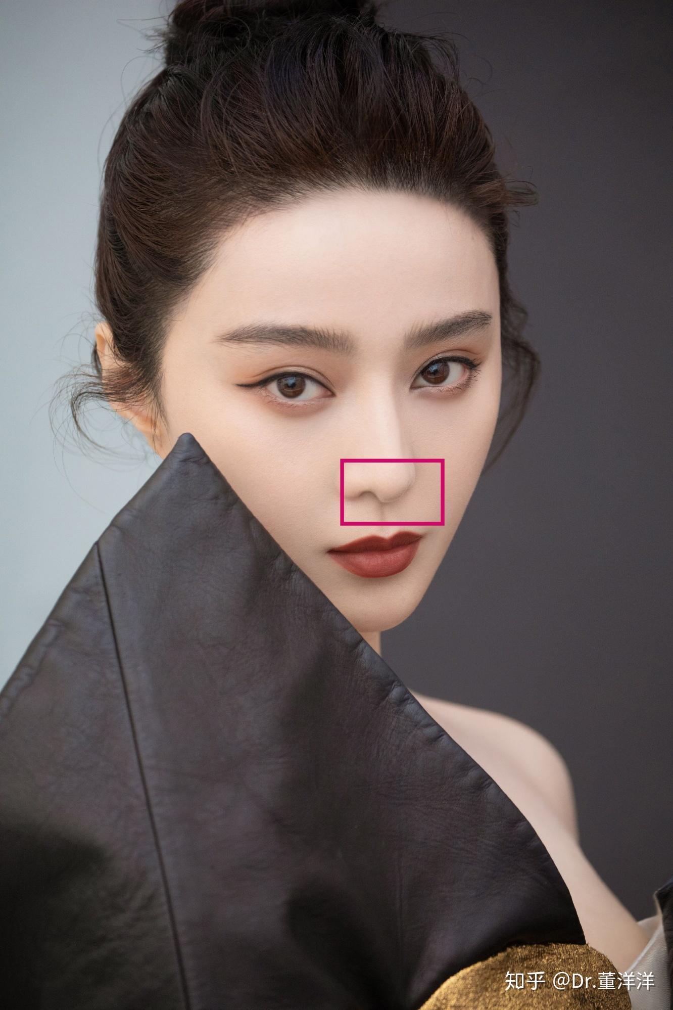 鼻翼鼻翼宽,肥大让鼻子有一种笨拙感,我们常见的肉头鼻,大蒜鼻就有