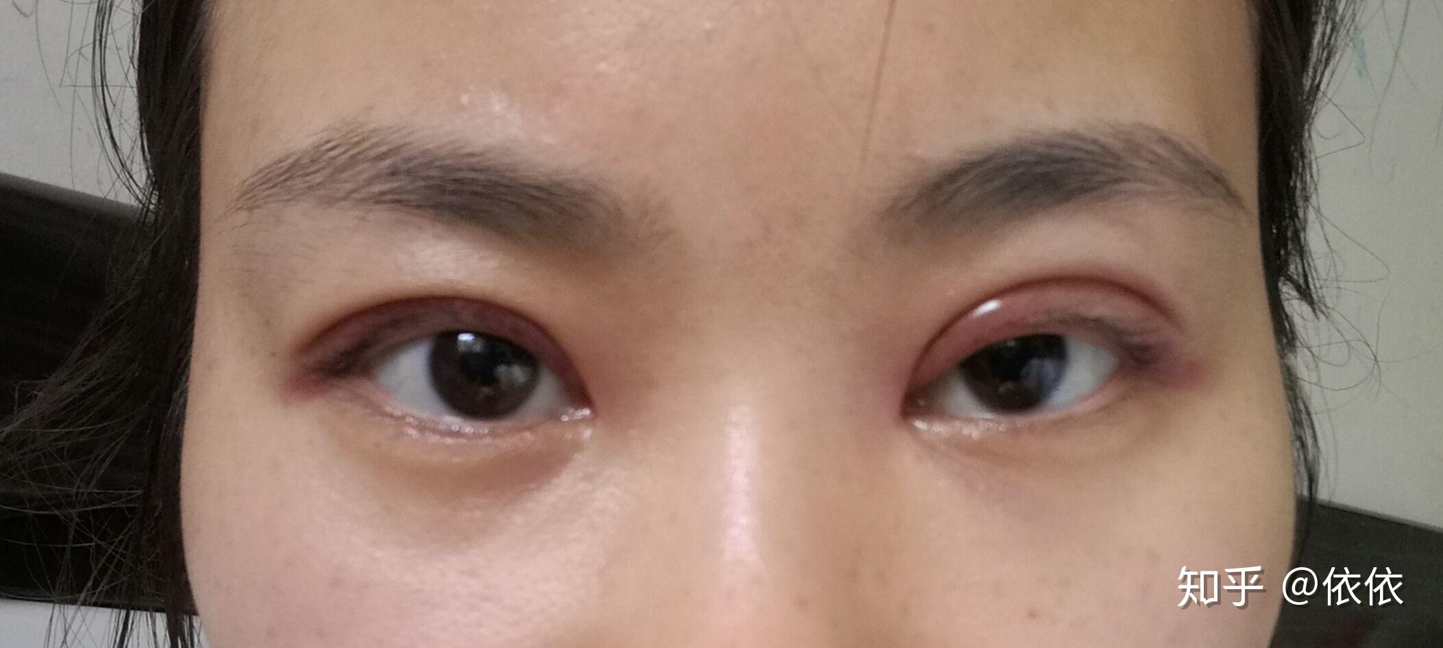 一个失败的双眼皮过程