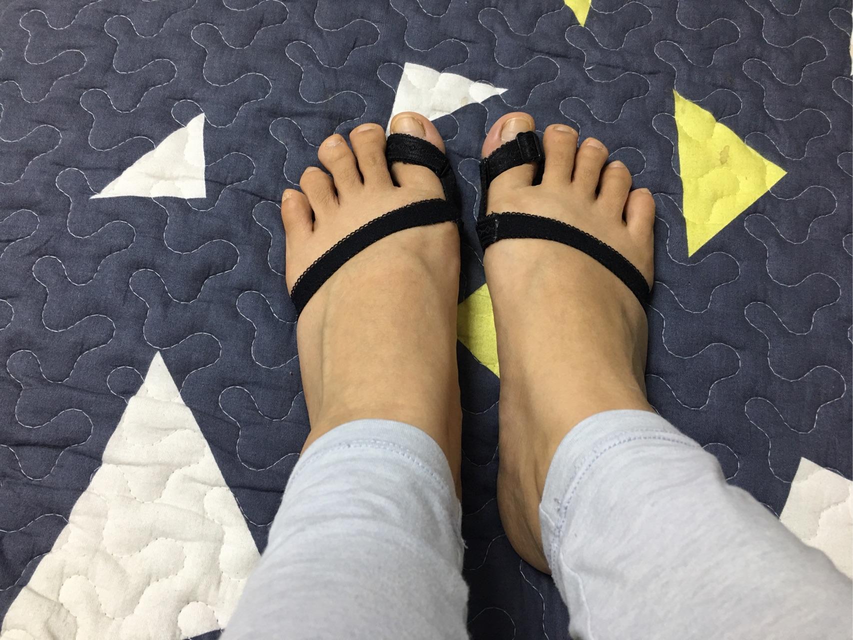 女生脚趾拇外翻是什么样体验