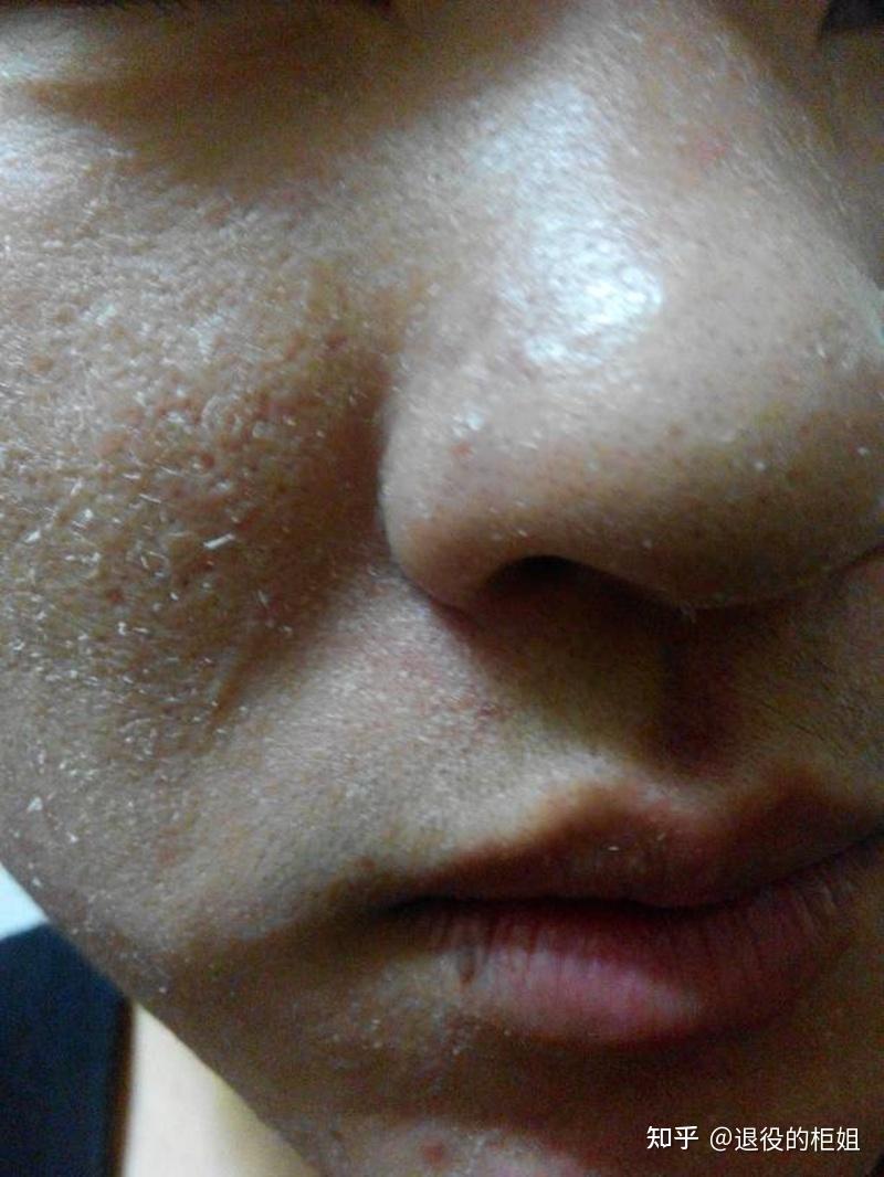 为什么我洗脸之后发红紧绷发疼,甚至还会脱皮脱屑? - 知乎