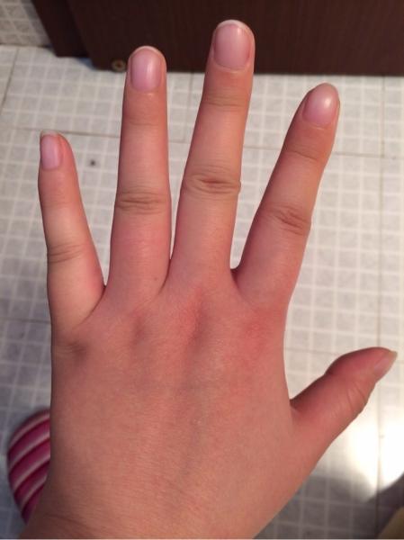 我的手有时会在病情严重时轻微水肿你不是吗