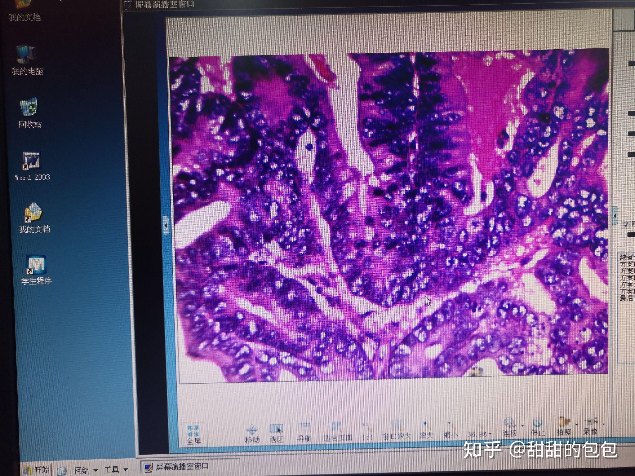 细菌性痢疾病理切片图片