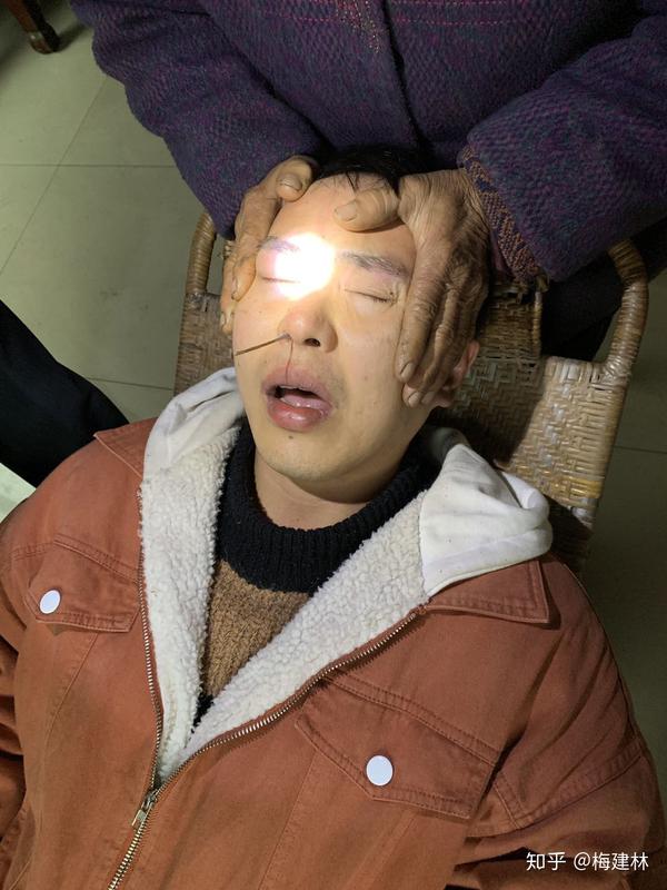 鼻窦炎治疗过程
