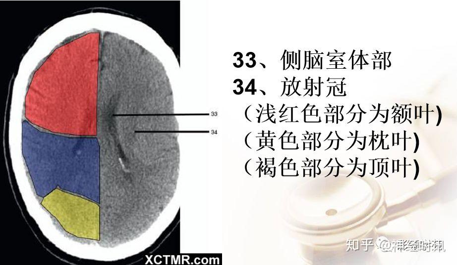 解剖影像腦實質ct斷層解剖