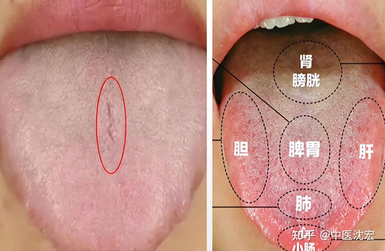 舌头有裂纹图解图片