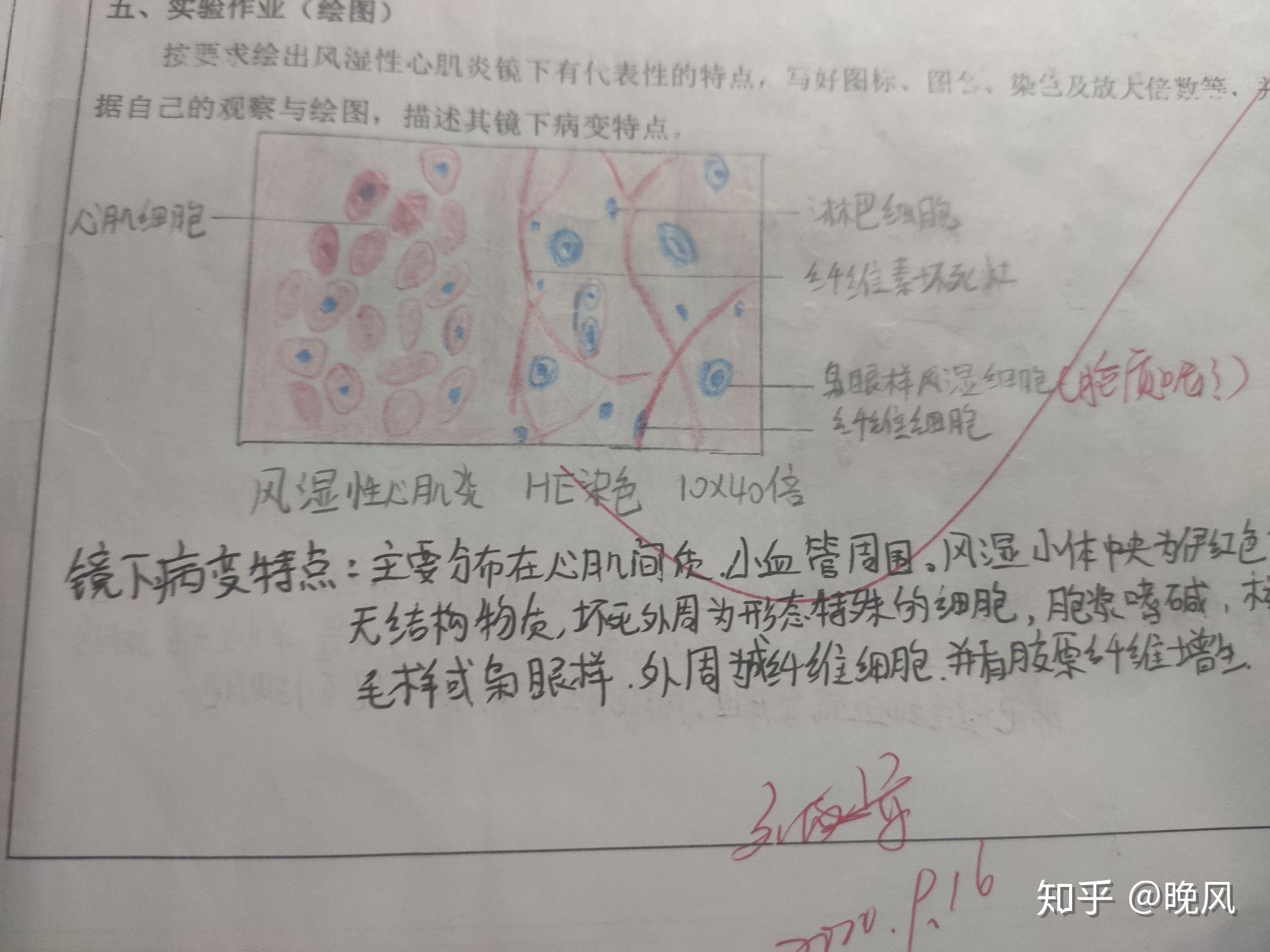 慢性肝淤血1肝脂肪变性学渣字丑,图画的丑,将就一下