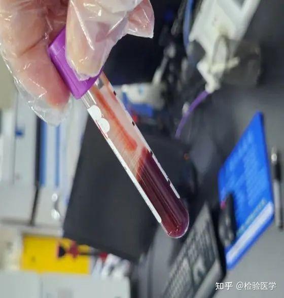 标本严重溶血惹的祸？一例慢性肾衰合并横纹肌溶解症诊断的思考 - 知乎