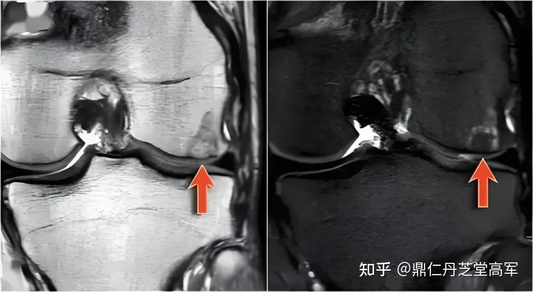 膝关节骨岛是怎么一回事?