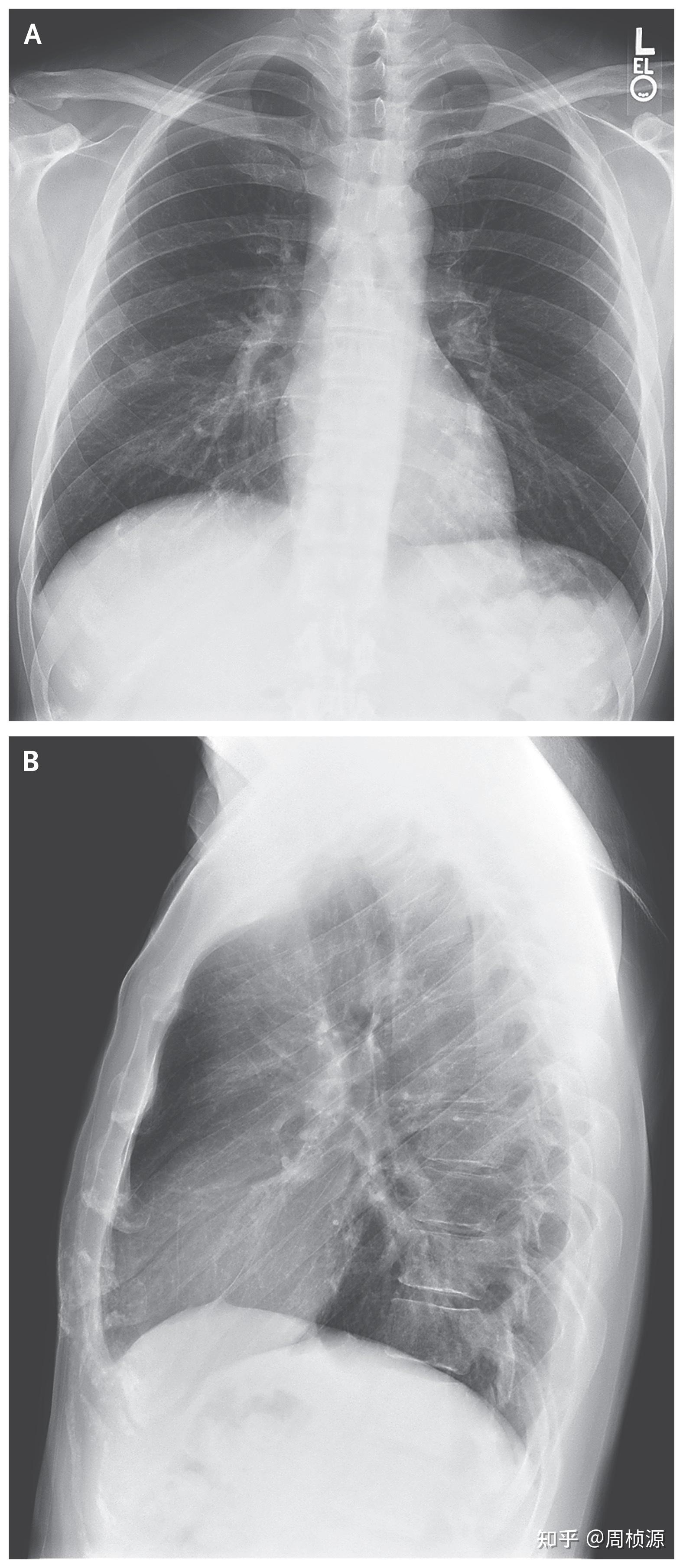 nejm2014case23