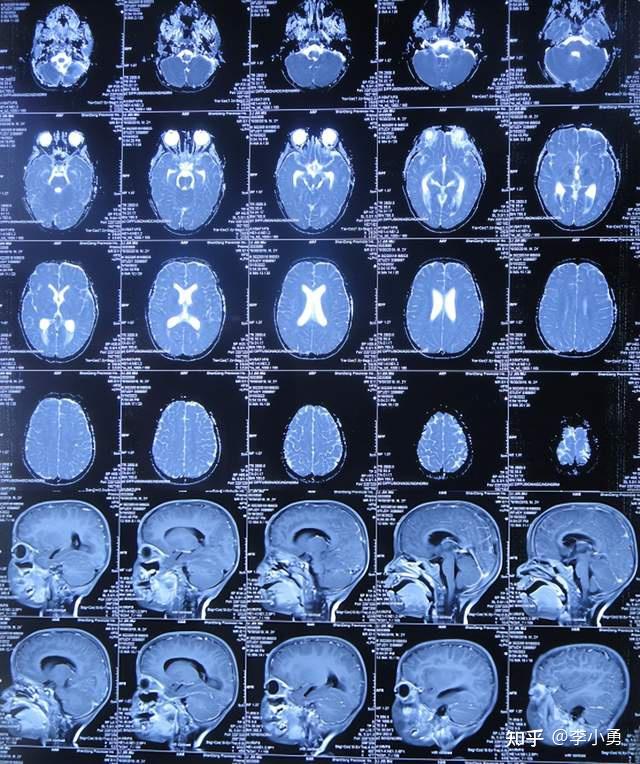 患兒先天性脊髓栓系術後近2年發生顱內感染和腦積水右腿癱性走路不能