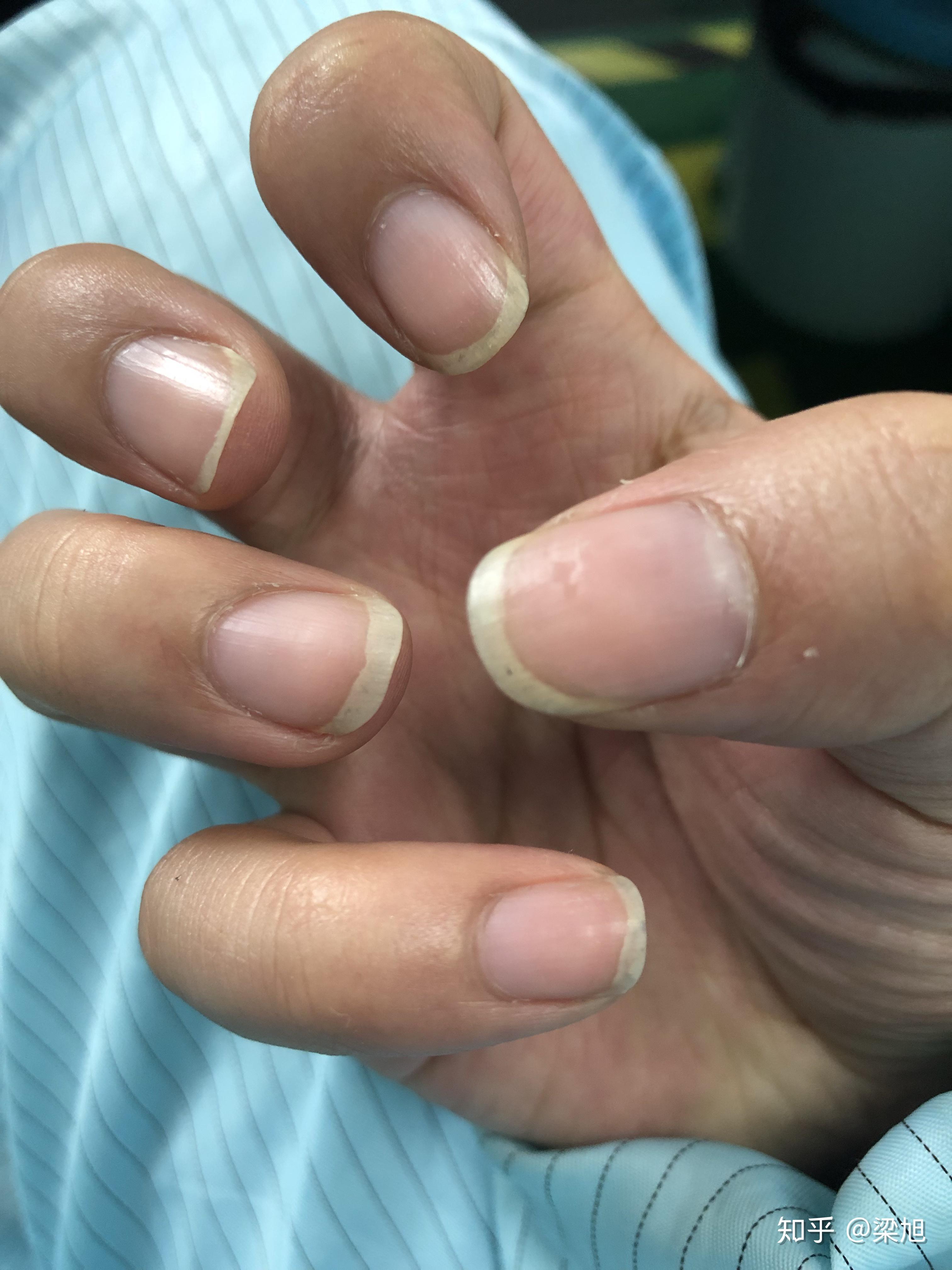 甲床过短应该如何变长