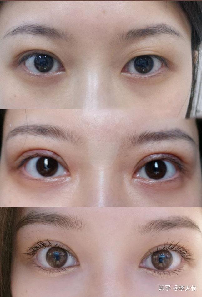 肿眼泡抽脂眼皮会松弛吗