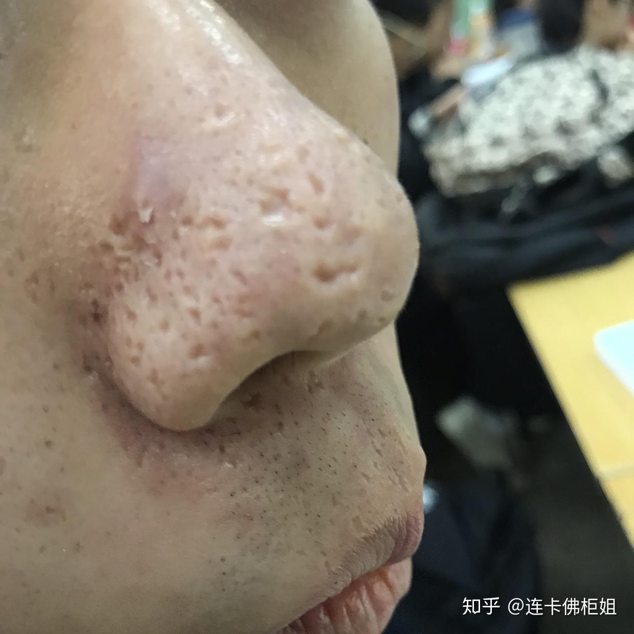 美容院的韩国超微小气泡是什么去黑头效果好吗自己可以在家里做吗