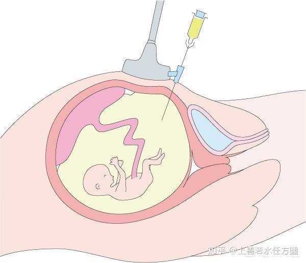 怀孕多久可以做nt v2-1c5c4f03e5b5ae8ef8724cb168a3783c_r.jpg