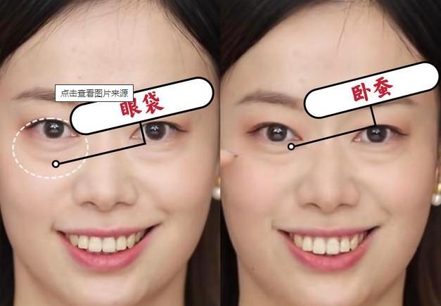 很多人都很好奇卧蚕和眼袋有什么区别还有不少人误将卧蚕当眼袋