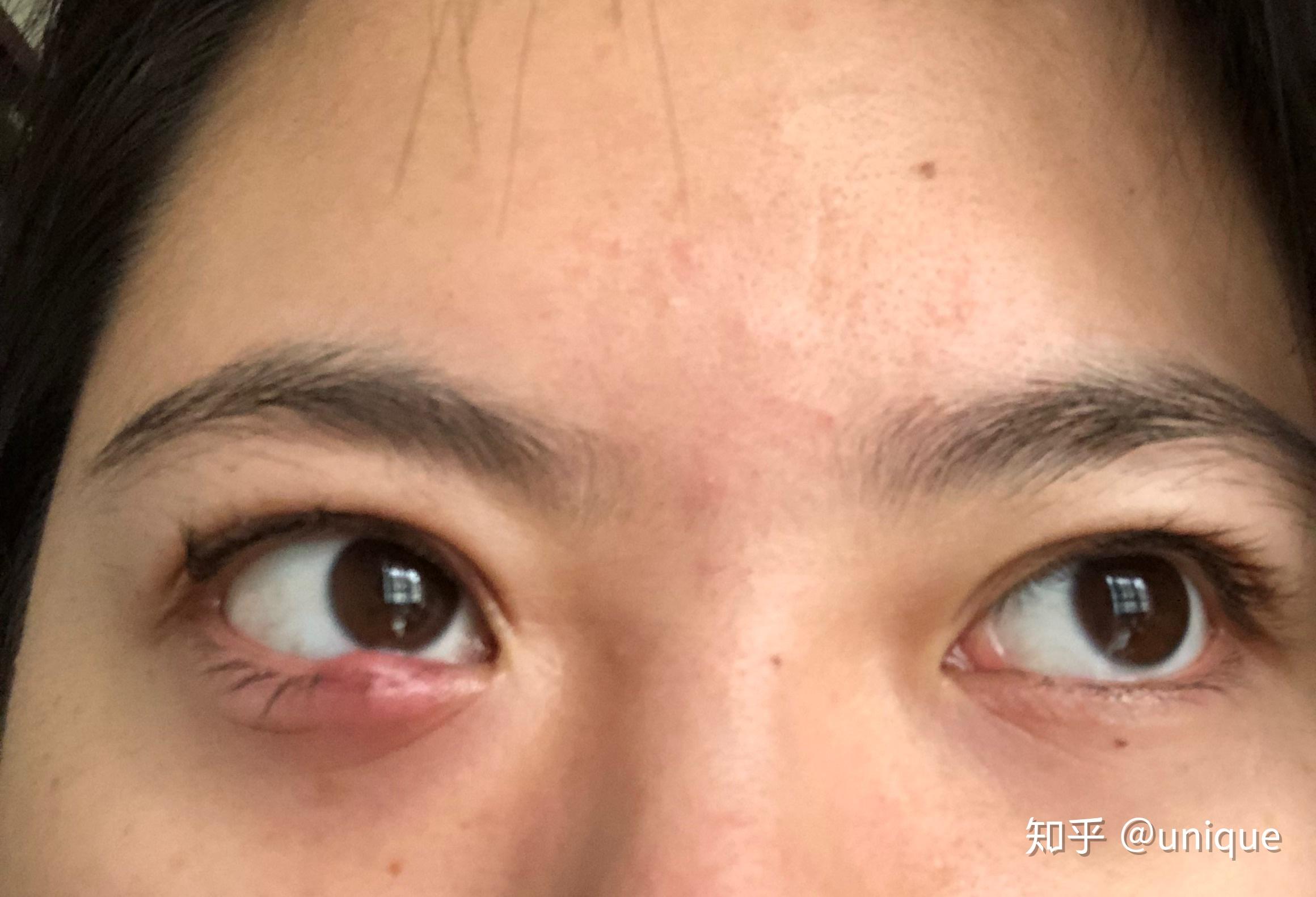 眼睛肿胀疼痛是因为什么