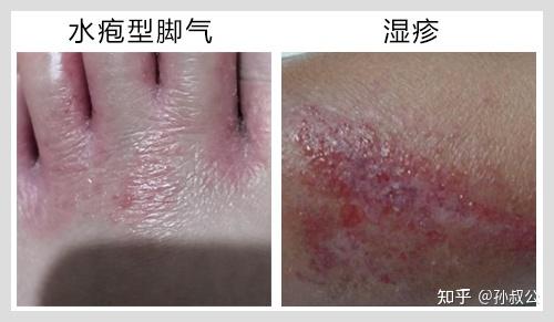 脚气和湿疹有什么区别? - 知乎